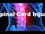 What is spinal cord injury? Common types of back injuries and how can you prevent? what is spinal chord injury