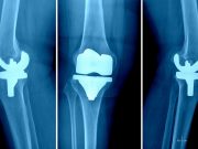 Best Knee Replacement surgeons in Hyderabad