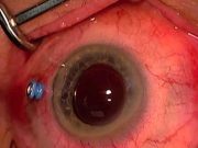 Knowing all about vitrectomy surgical procedure vitrectomy surgical procedure