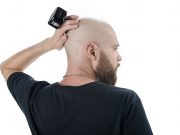 Can you get a Hair Transplant if you are completely bald? Hair Transplant if you are completely bald