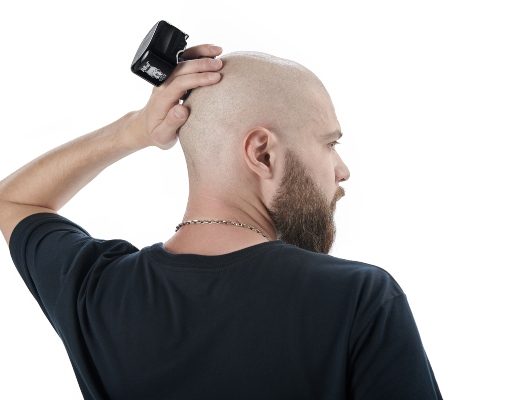 Can you get a Hair Transplant if you are completely bald? Hair Transplant if you are completely bald