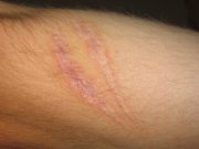 Secrets About Wound Healing And Repair Of Scars That Nobody Will Tell You Wound Healing And Repair Of Scars