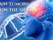 Brain Tumors: Know the Signs Brain Tumors Know the Signs